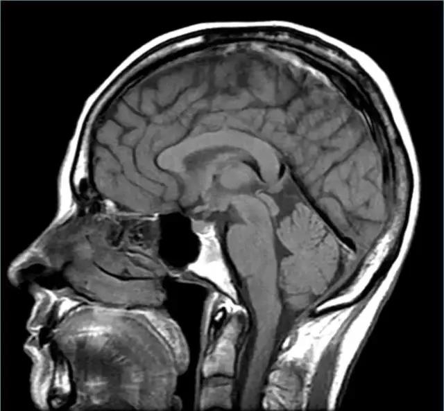 馬斯克腦機融合系統Neuralink